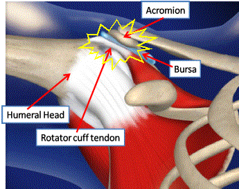 shoulder impingement diagnosis