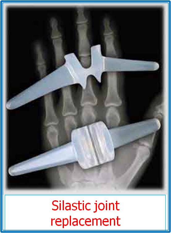 How successful is surgery to replace the joint at the base of the thumb?